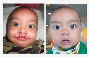 Before & After reconstructive surgery