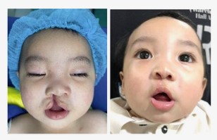 Before & After reconstructive surgery